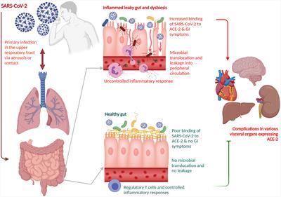 SARS-CoV-2-Indigenous Microbiota Nexus: Does Gut Microbiota Contribute to Inflammation and Disease Severity in COVID-19?